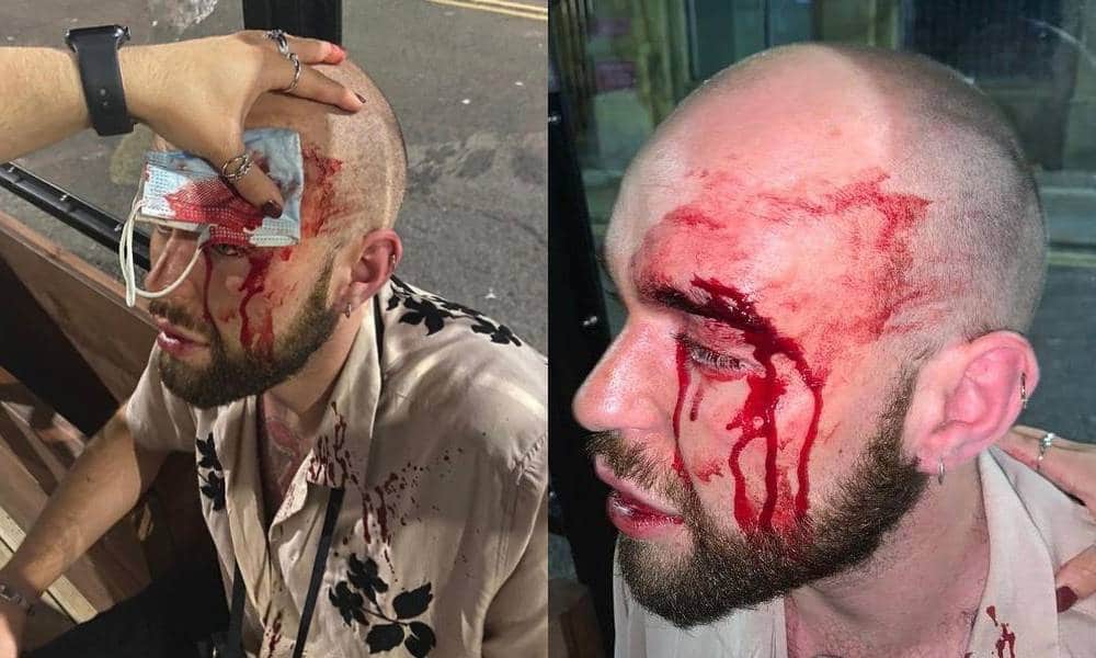 La policía afirma que la terrorífica oleada de brutales ataques homófobos en Liverpool 