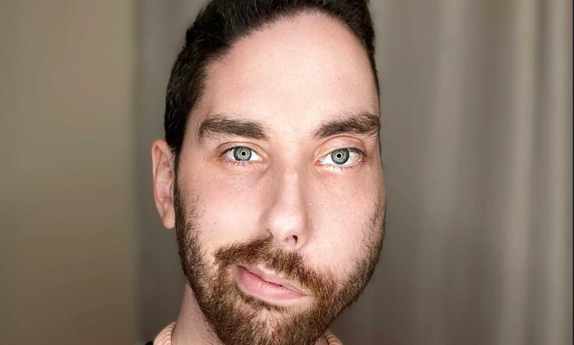 Un influencer gay se sincera sobre sus citas con un defecto facial de nacimiento