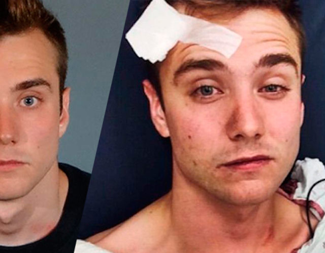 El youtuber Calum McSwiggan se inventa haber sido víctima de un ataque homófobo