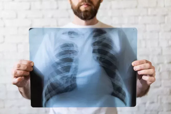 A man holds up a chest x-ray, showing lungs
