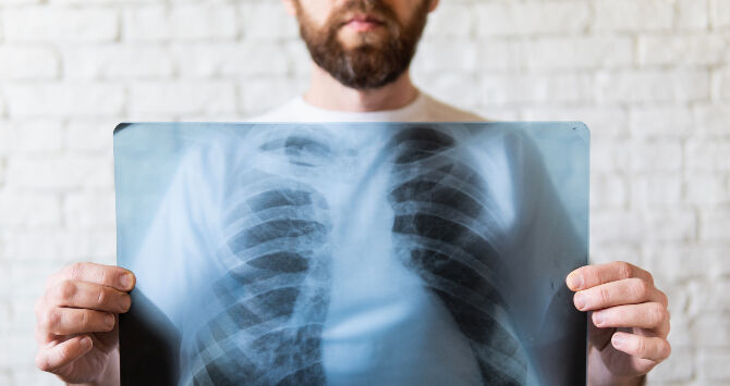 Las personas con VIH tienen el doble de riesgo de padecer cáncer de pulmón