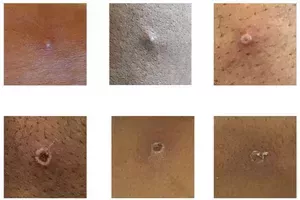 Monkeypox lesions