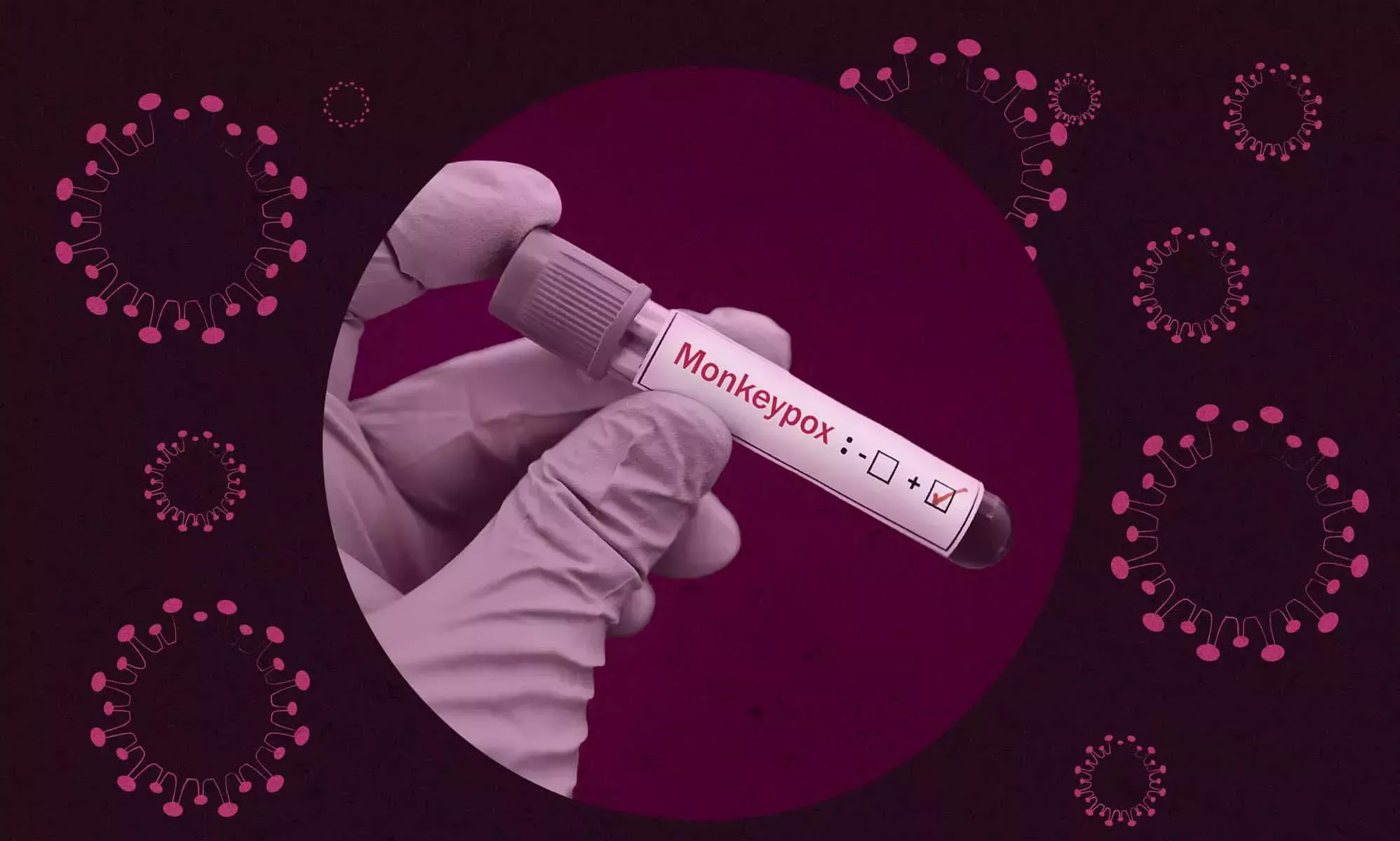 Un estudio sobre la viruela del mono y el VIH pone de relieve la importancia del tratamiento para salvar vidas