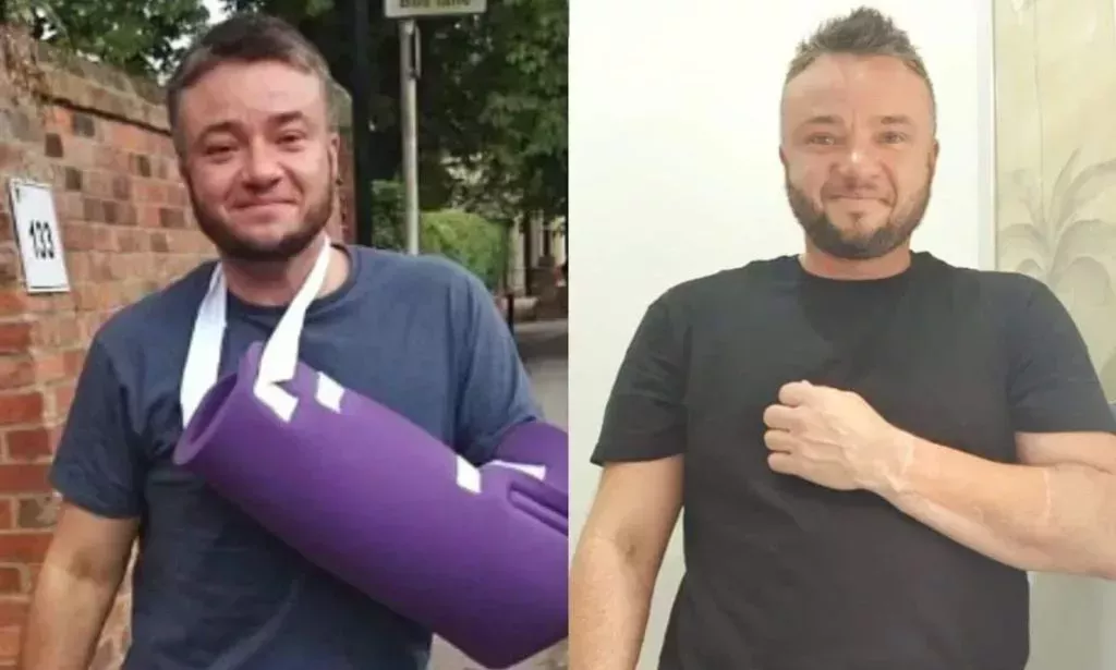 A split image of Finlay Games during his recovery from phalloplasty.