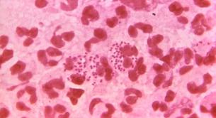 Detección y tratamiento de la gonorrea, la ETS invisible