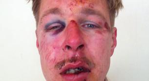 "La cara de la homofobia": impactante foto del gay atacado en Francia