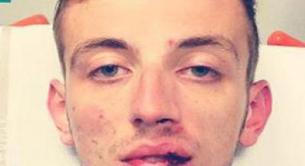 Homofobia en Francia: nueva foto de otro gay atacado